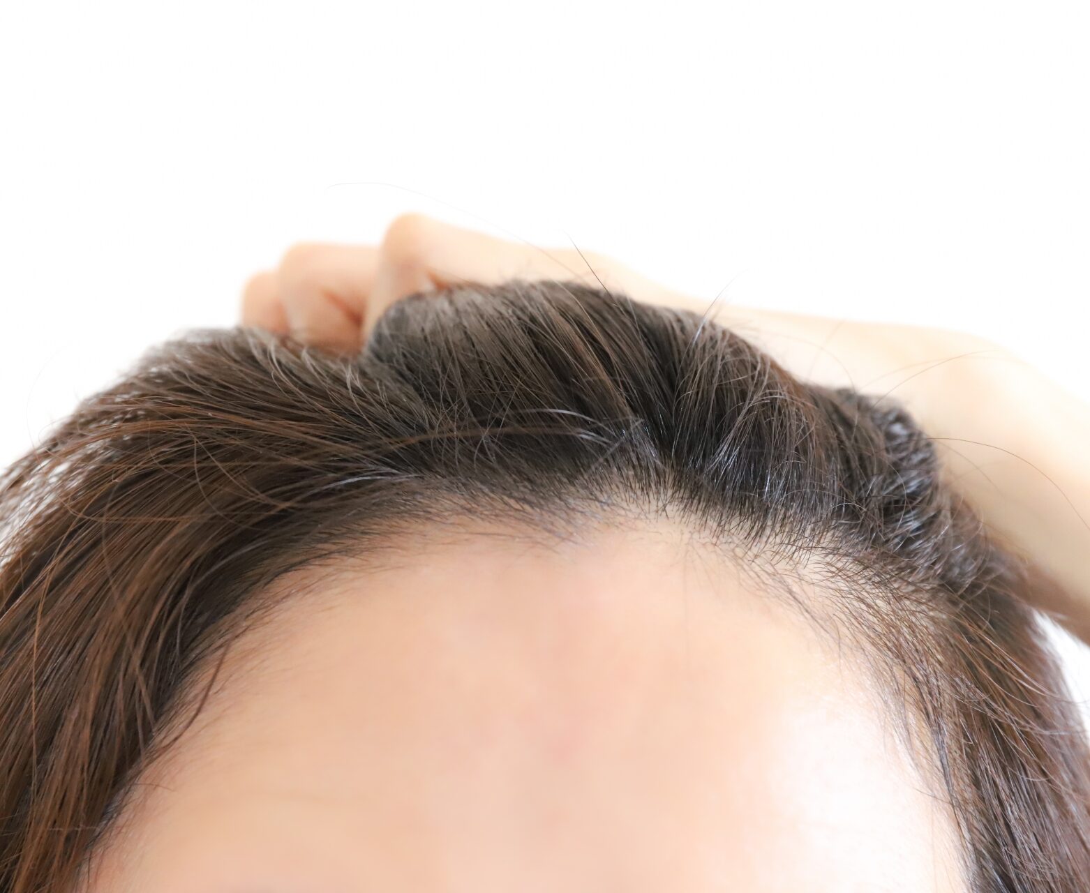 女性の薄毛(FPHL)